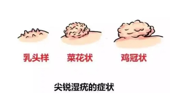 微信截图_20230916145945 成都尖锐湿疣医院