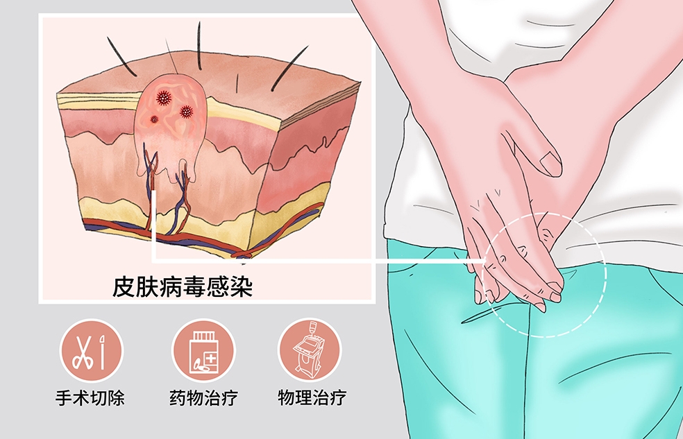 微信截图_20231007100757 成都尖锐湿疣医院